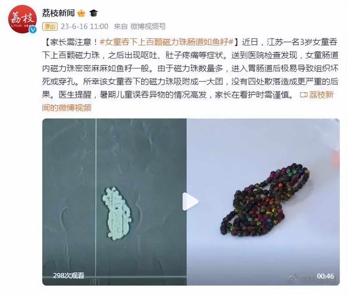 女童吞下上百颗磁力珠肠道如鱼籽(过程惊心动魄)(图1) 女童吞下上百颗磁力珠肠道如鱼籽(过程惊心动魄)(图1)